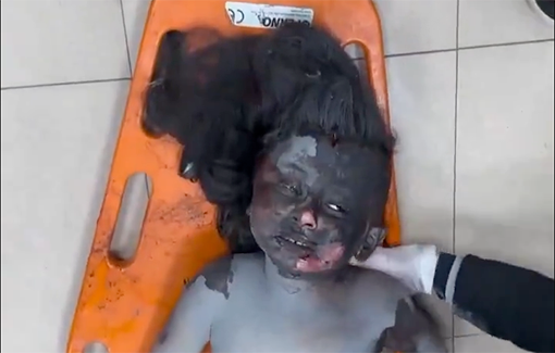 Thumbnail preview image for the video titled: Burned child transported to hospital floor for treatment