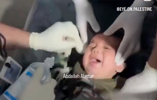 Thumbnail preview image for the video titled: Doctors remove shrapnel from the eye of a baby