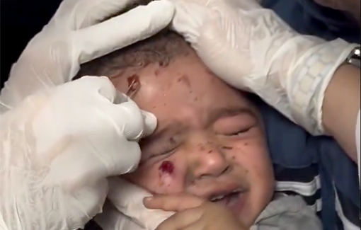 Thumbnail preview image for the video titled: Doctors removing shrapnel from a baby's face