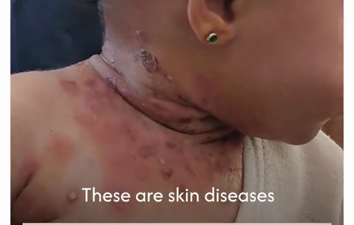 Thumbnail preview image for the video titled: Infant with skin disease, no treatment available as IDF blocks aid