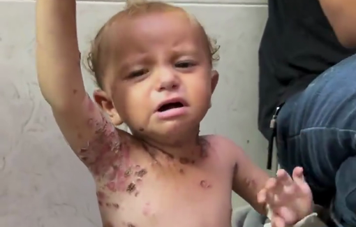 Thumbnail preview image for the video titled: Children in Gaza suffer from severe skin diseases due to pollution and IDF destruction of water infrastructure