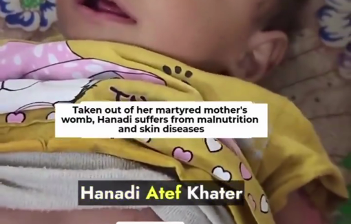 Thumbnail preview image for the video titled: Skin disease afflicts baby Hanadi saved from her killed mother's womb