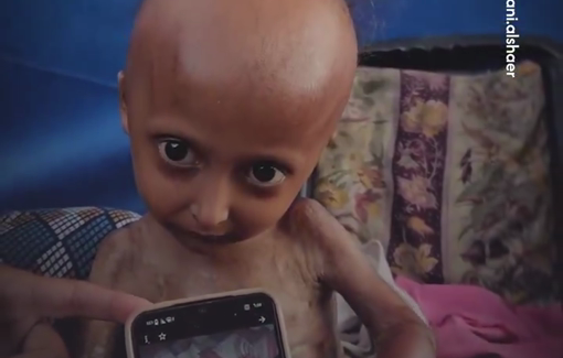 Thumbnail preview image for the video titled: Disabled child Hala Al-Hanadi's condition worsens from malnutrition due to the Israeli siege