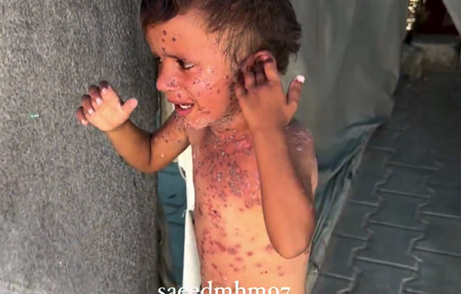 Thumbnail preview image for the video titled: Toddler cries in pain from skin disease