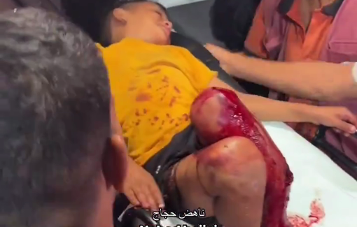 Thumbnail preview image for the video titled: Injured children arrive at Al-Aqsa Hospital