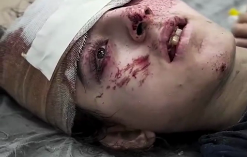 Thumbnail preview image for the video titled: Disabled girl injured in Israeli strike