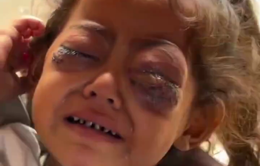 Thumbnail preview image for the video titled: Child with eye cancer knows nothing but pain amid Israel's destruction of healthcare