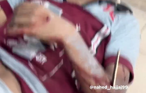 Thumbnail preview image for the video titled: Child Malek al-Udaini wounded and orphaned after Israeli strike